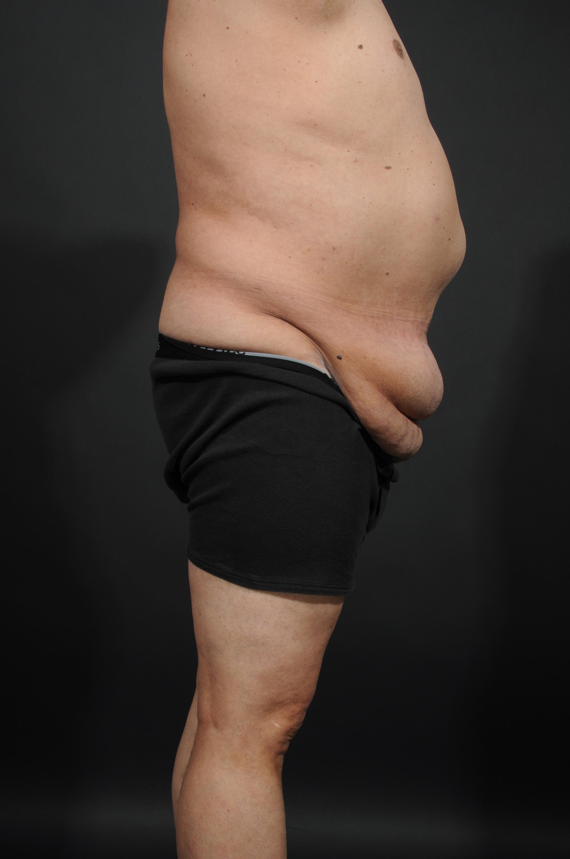 Tummy Tuck with Hernia Repair Before & After Image