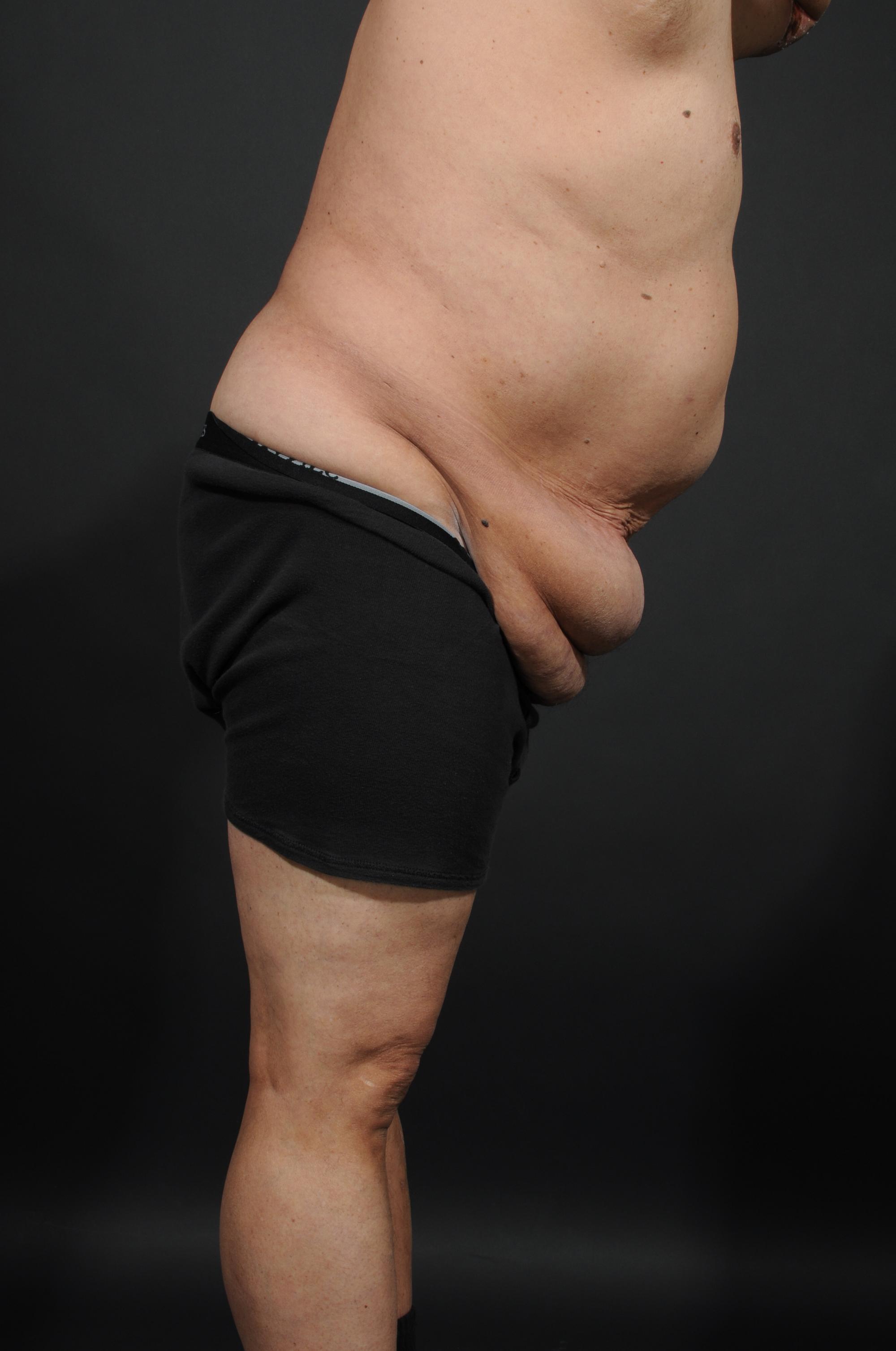 Tummy Tuck with Hernia Repair Before & After Image