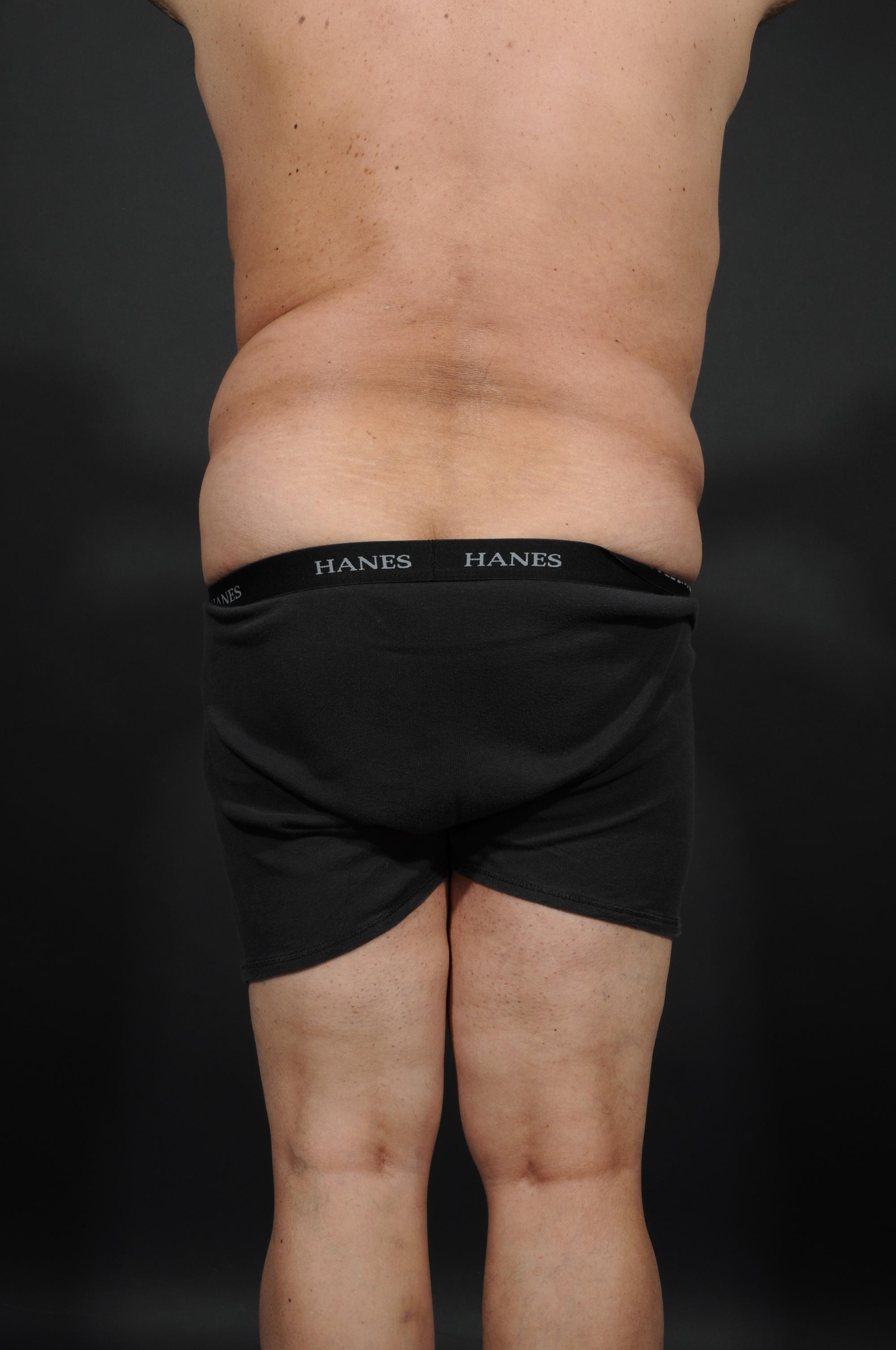 Tummy Tuck with Hernia Repair Before & After Image