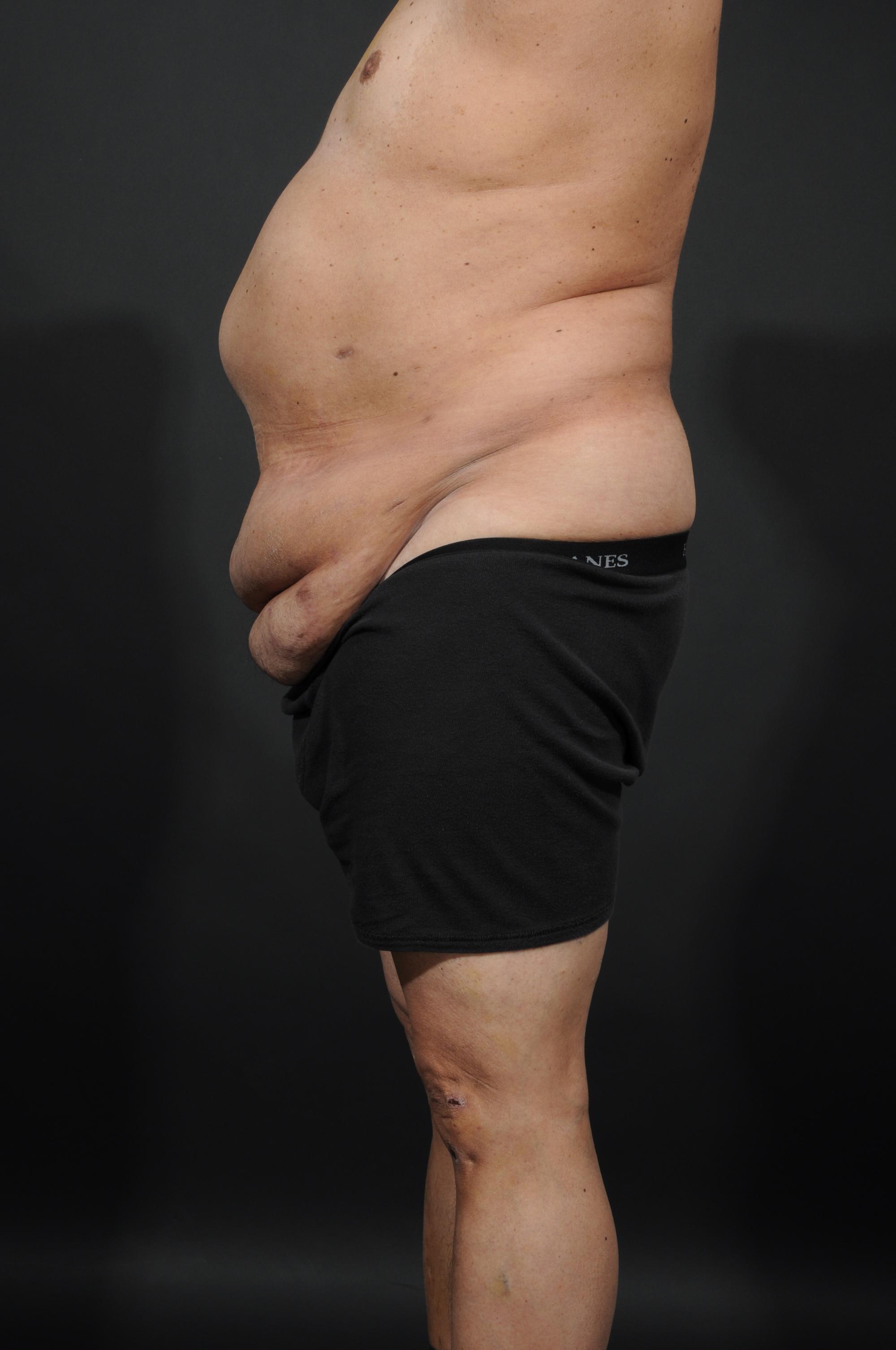 Tummy Tuck with Hernia Repair Before & After Image