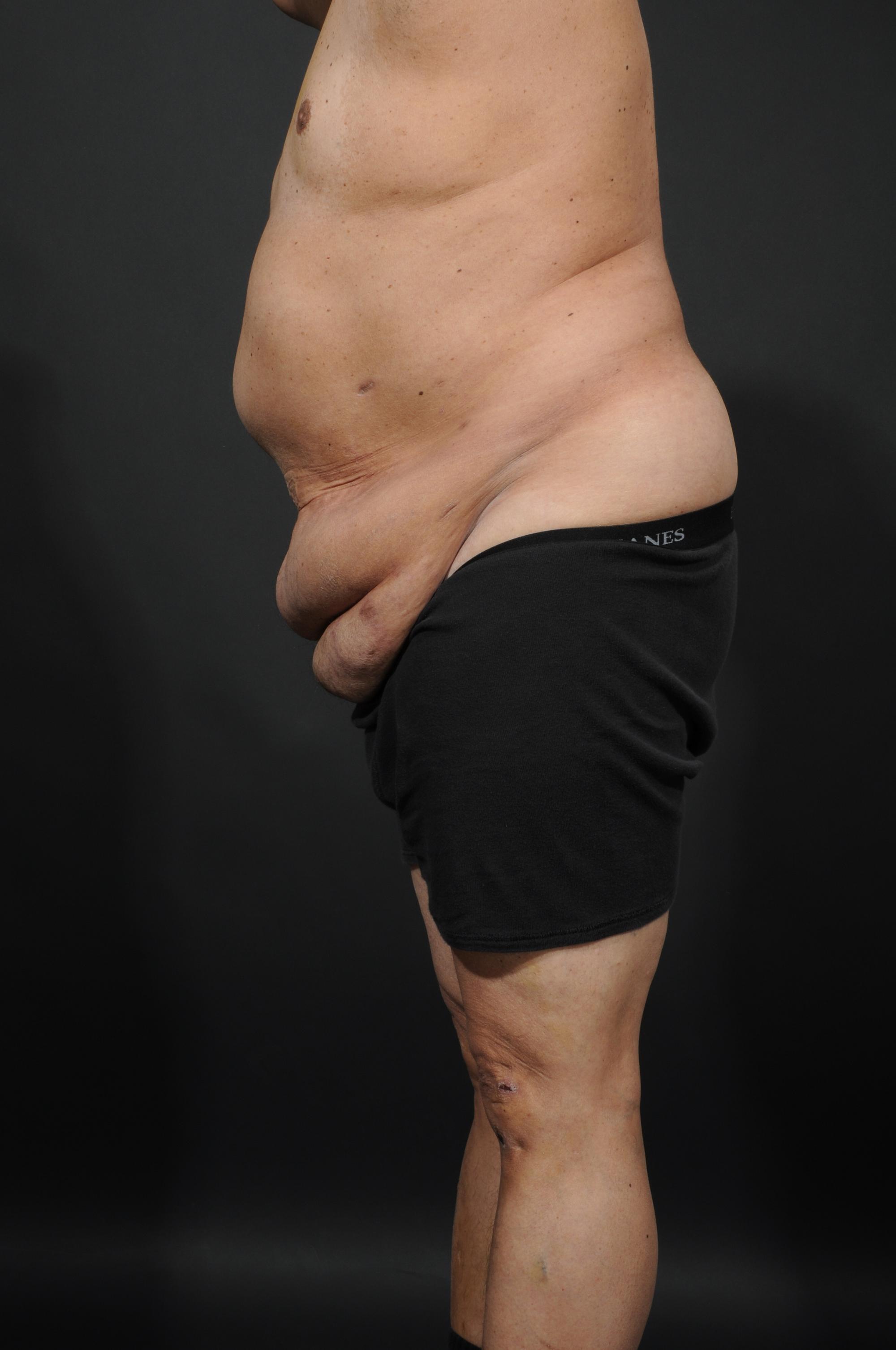 Tummy Tuck with Hernia Repair Before & After Image