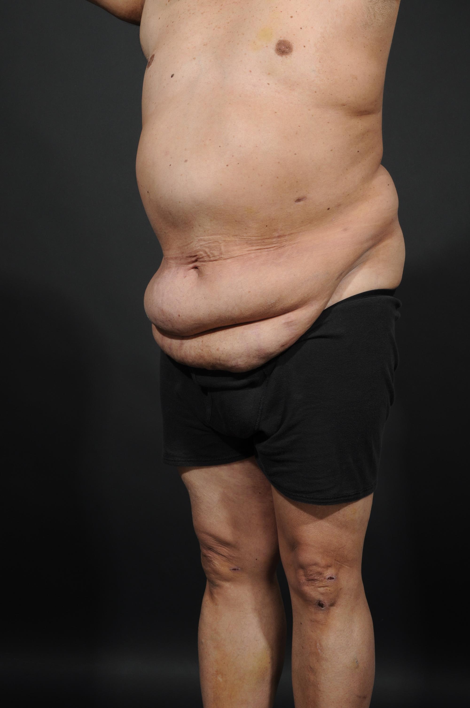 Tummy Tuck with Hernia Repair Before & After Image