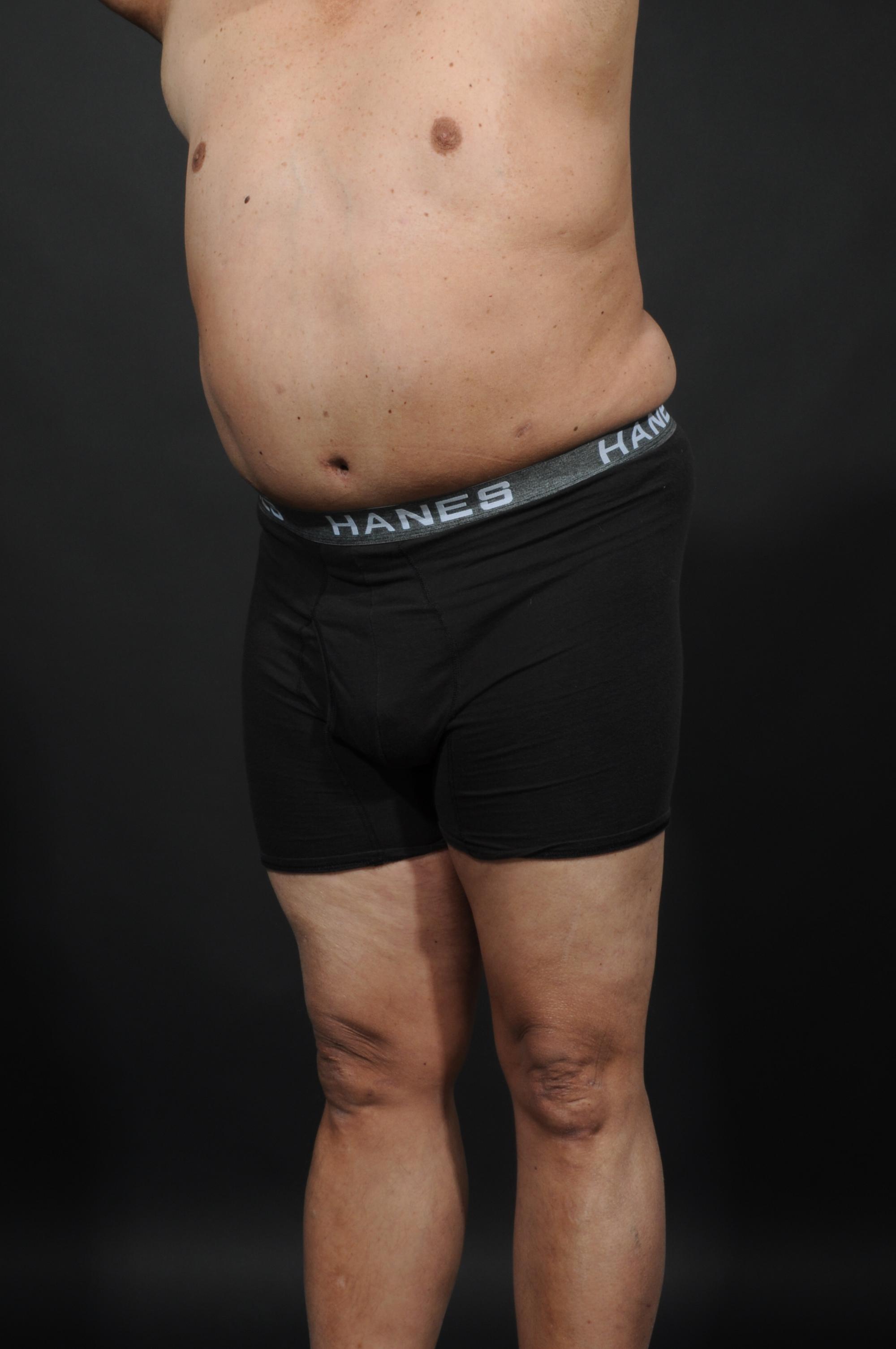 Tummy Tuck with Hernia Repair Before & After Image