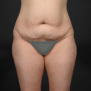 Tummy Tuck Before & After Image