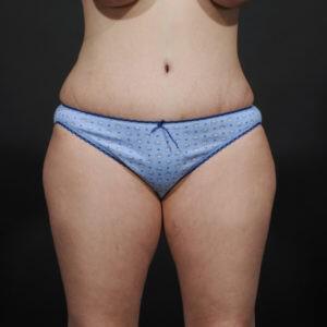 Tummy Tuck Before & After Image