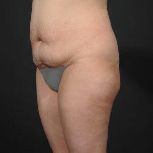 Tummy Tuck Before & After Image