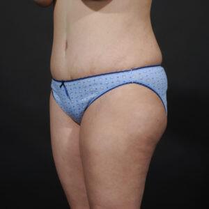 Tummy Tuck Before & After Image