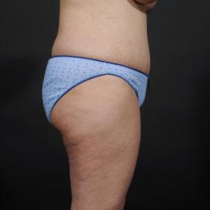 Tummy Tuck Before & After Image