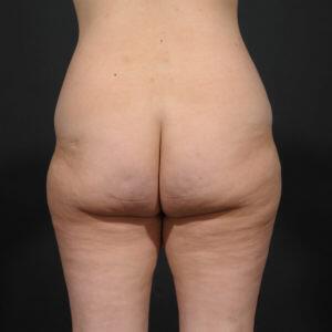 Tummy Tuck Before & After Image