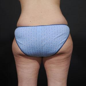 Tummy Tuck Before & After Image