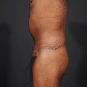 Tummy Tuck Before & After Image