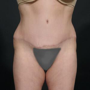 Tummy Tuck Before & After Image