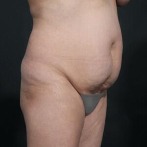 Tummy Tuck Before & After Image