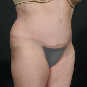 Tummy Tuck Before & After Image