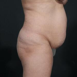 Tummy Tuck Before & After Image