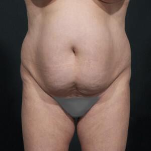 Tummy Tuck Before & After Image