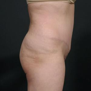 Tummy Tuck Before & After Image