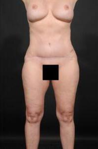 Tummy Tuck Before & After Image