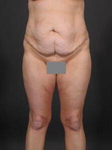 Tummy Tuck Before & After Image