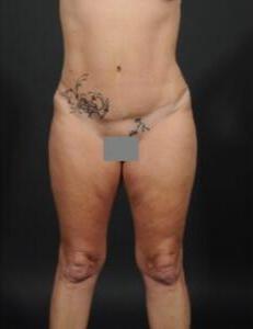 Tummy Tuck Before & After Image