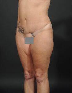 Tummy Tuck Before & After Image