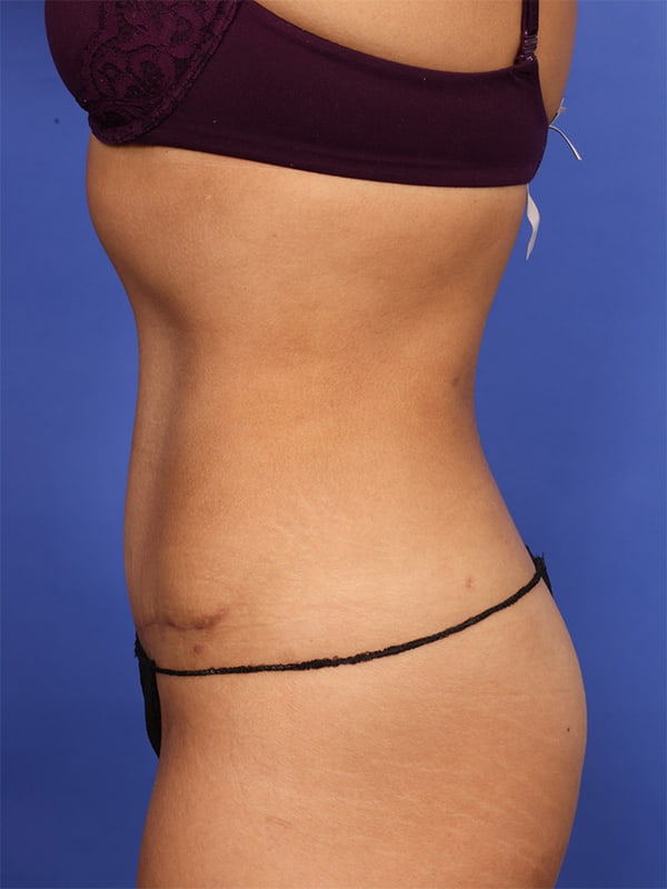 Tummy Tuck Before & After Image