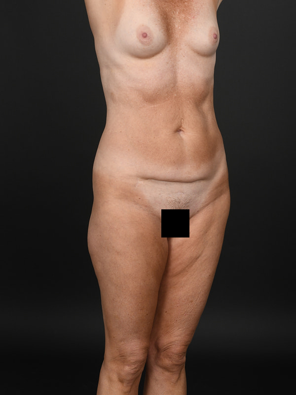 Tummy Tuck Before & After Image