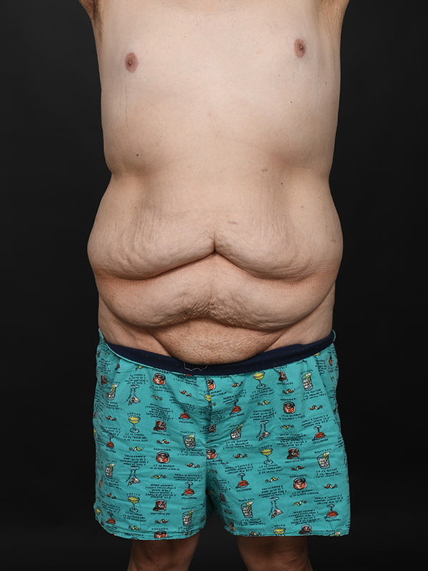 Tummy Tuck Before & After Image