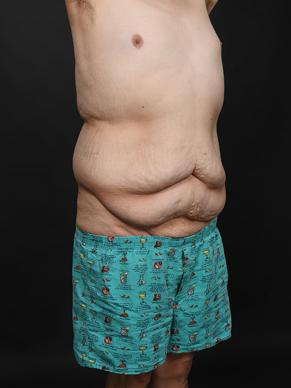 Tummy Tuck Before & After Image