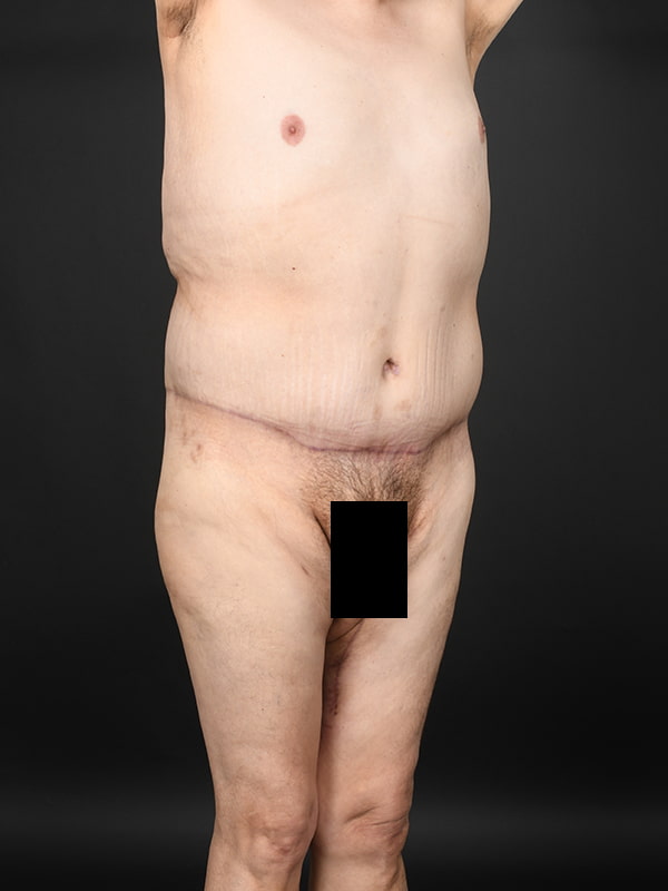 Tummy Tuck Before & After Image