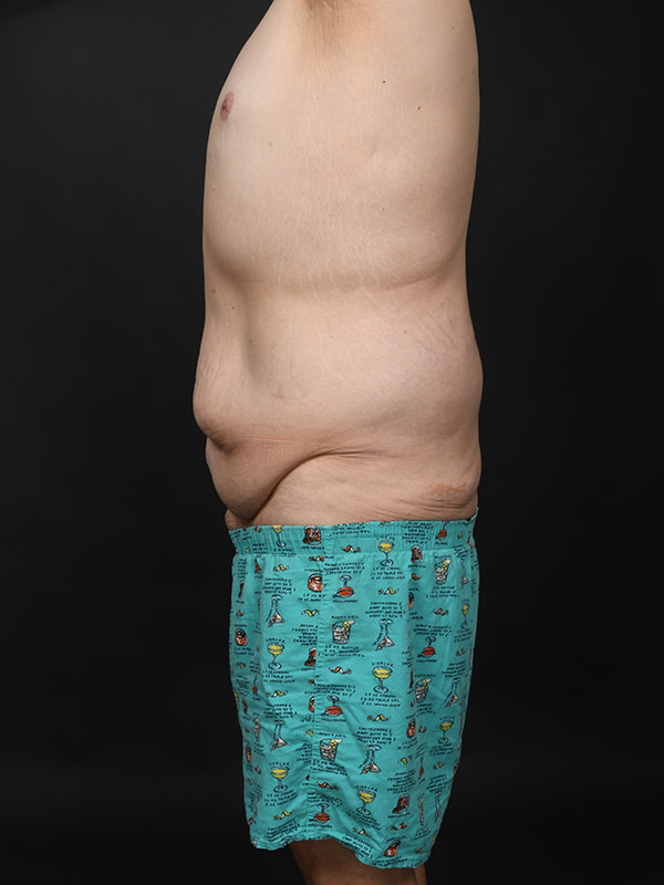 Tummy Tuck Before & After Image