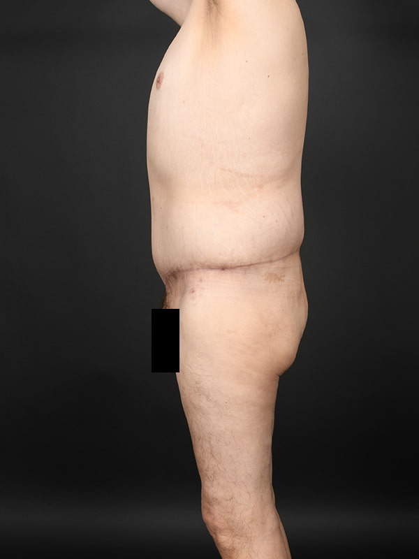 Tummy Tuck Before & After Image