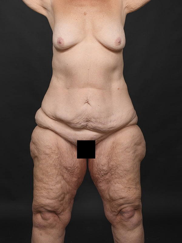 Tummy Tuck Before & After Image