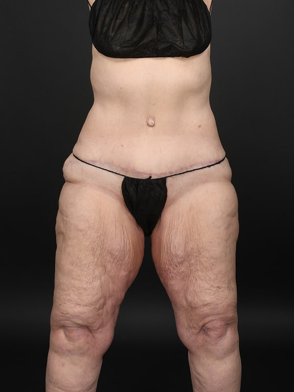 Tummy Tuck Before & After Image