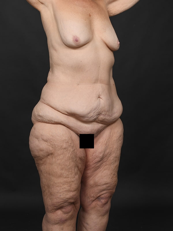 Tummy Tuck Before & After Image