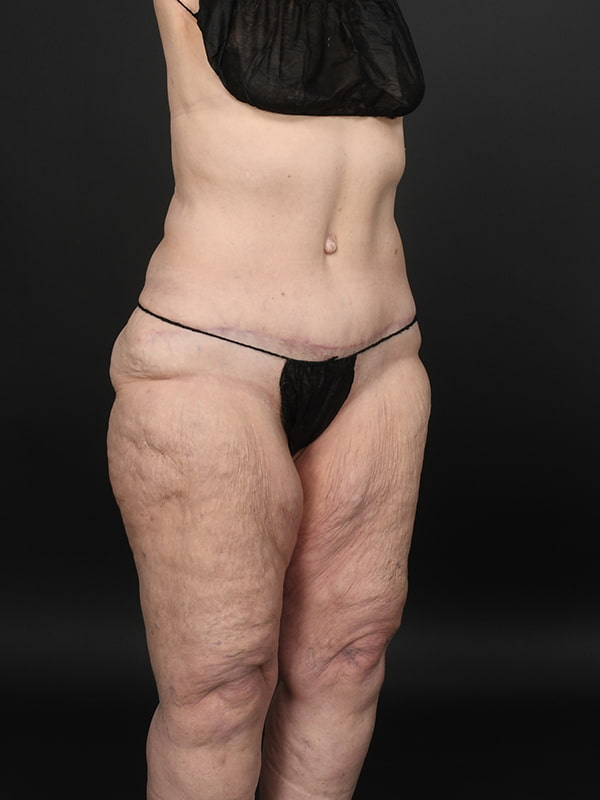 Tummy Tuck Before & After Image