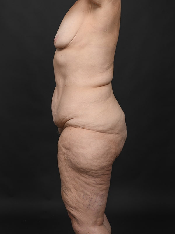 Tummy Tuck Before & After Image