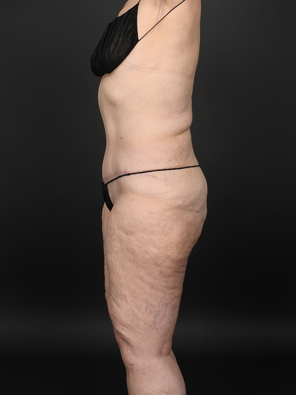 Tummy Tuck Before & After Image