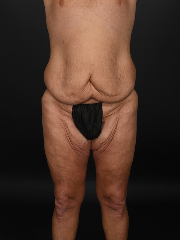 Tummy Tuck Before & After Image