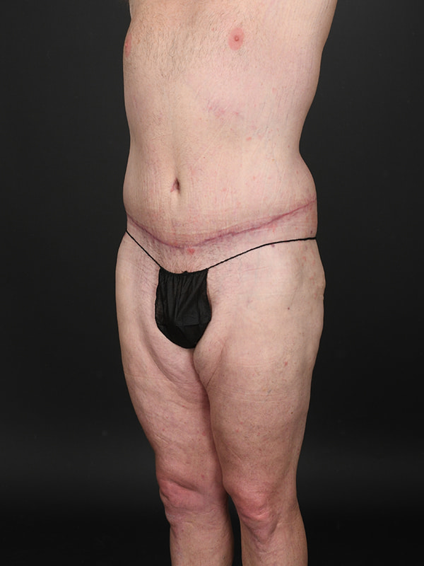 Tummy Tuck Before & After Image