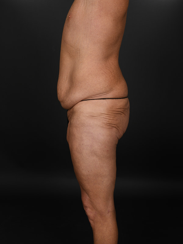 Tummy Tuck Before & After Image