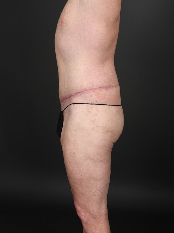 Tummy Tuck Before & After Image