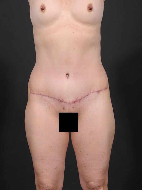 Tummy Tuck Before & After Image