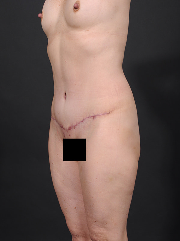 Tummy Tuck Before & After Image