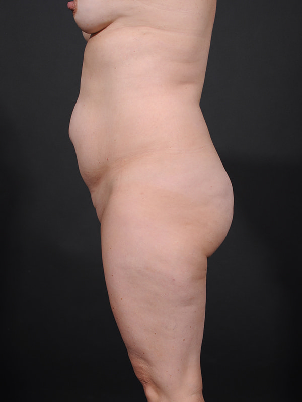 Tummy Tuck Before & After Image