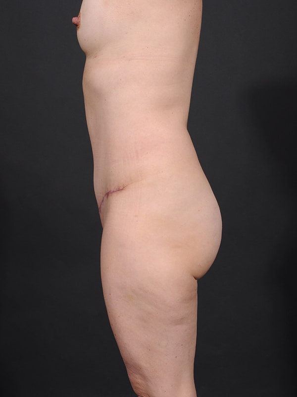 Tummy Tuck Before & After Image
