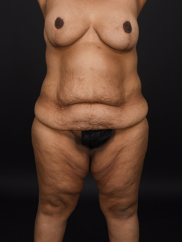 Tummy Tuck Before & After Image