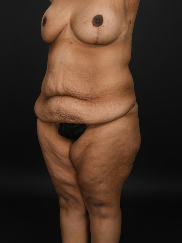 Tummy Tuck Before & After Image