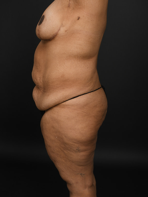Tummy Tuck Before & After Image