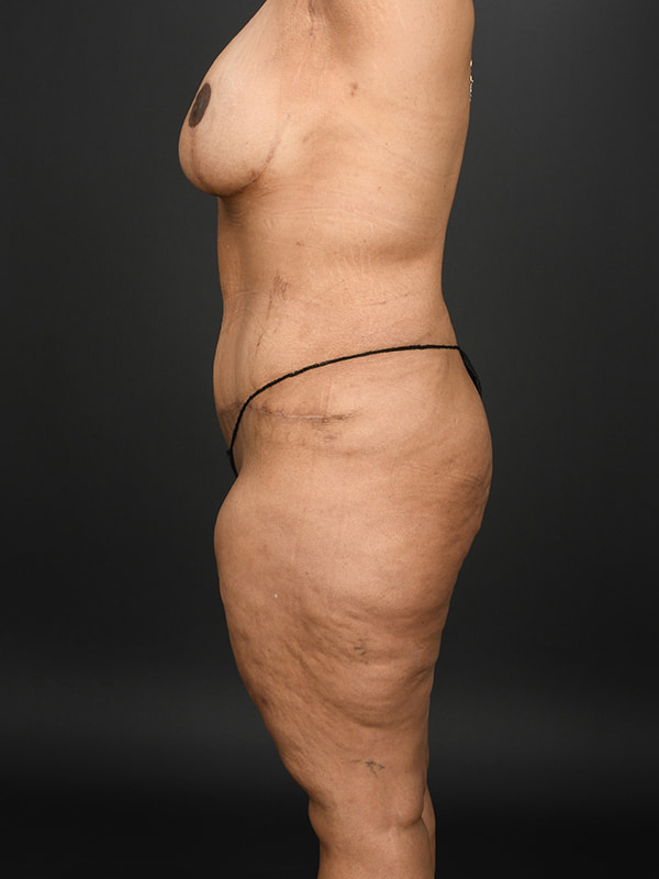 Tummy Tuck Before & After Image